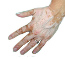 ayurvedic leucoderma clinic in vaishali delhi india