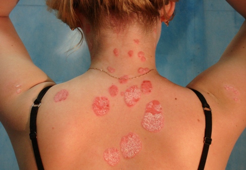 ayurvedic treatment for psoriasis and eczema in delhi
