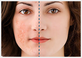 ayurvedic treatment for pimples in delhi